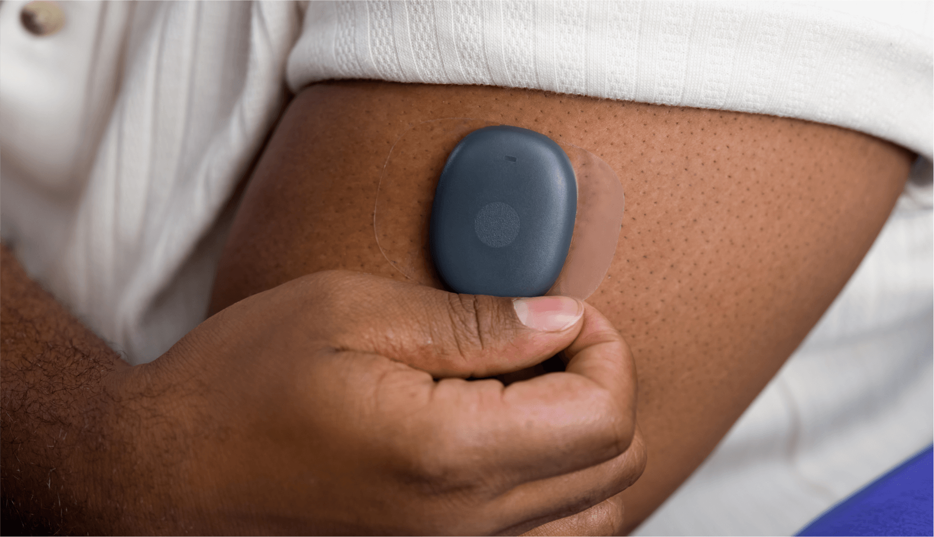 Eversense Benutzer bringt CGM Gerät am Oberarm an, in einer Nahaufnahme.